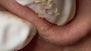 Ultimate Guide to Removing Blackheads and Whiteheads 👃🐽🤢 removeblackhead [upl. by Herby]