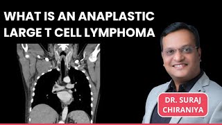 What is Anaplastic Large T Cell Lymphoma  Sign amp Symptoms Treatment Options by Dr Suraj Chiraniya [upl. by Magda483]