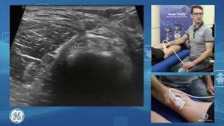 Sonographic assessment of the posterior knee for POCUS clinicians [upl. by Nycila813]