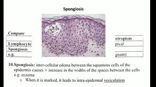 Histopathology 3 👉 acantholysis amp spongiosis amp ballooning [upl. by Llerrehc]