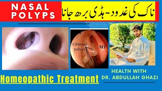 Nasal Polyps  ناک کی غدود ہڈی برھ جانا  Homeopathic Treatment  Dr Abdullah Ghazi [upl. by Lucrece]