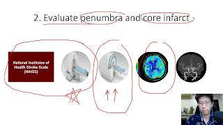 Acute stroke management 2022 [upl. by Mathre]