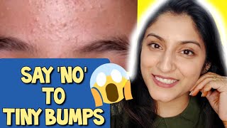 7 Days Challenge 😲 Treat TINY BUMPS on FOREHEADSFACE NATURALLY  100 Works Home Remedy [upl. by Yxel]