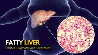 Fatty Liver Causes Signs and Symptoms Diagnosis and Treatment [upl. by Enilemme]