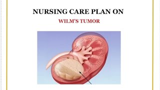 Nursing Care Plan Wilms tumor with 4 Diagnosis WILMS TUMOR pediatrics nursingcareplan [upl. by Elvyn]