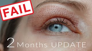 UPDATE 2 Months after fibroblast  FAIL [upl. by Yvon536]