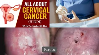 Cervical Cancer Hindi Part 01  Demography amp Screening  DrOzaConnects in Hindi  Dr Nisheeth Oza [upl. by Neff180]