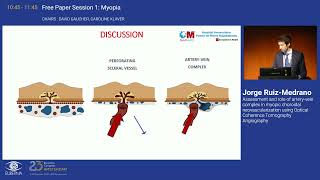 1 Assessment and role of arteryvein complex in myopic choroidal neovascularization using OCT [upl. by Adiela]