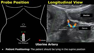 How To Scan The Uterine Artery  Doppler Ultrasound Probe Positioning  Transducer Placement USG [upl. by Adilem]