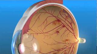 Retinopatía Diabética Proliferativa RDP [upl. by Eiraminot]