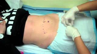 CoolSculpting Fat Removal With Dr Tom Pousti [upl. by Ynoffit574]