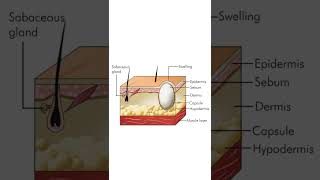 Sebaceous cyst  General Surgery [upl. by Odlavu]