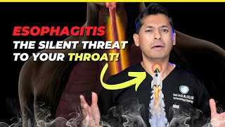 Esophagitis The Silent Threat to Your Throat [upl. by Acinomal]