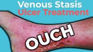 Venous Stasis Ulcer Treatment  Wound Care OC [upl. by Gamal]