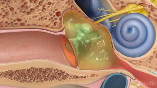 Ruptured eardrum perforated eardrumTreatment for eardrum rupture [upl. by Vharat]