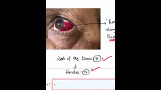 SubConjunctival Hemorrhage SCH  Case Discussion In A Minute Shorts [upl. by Boys806]