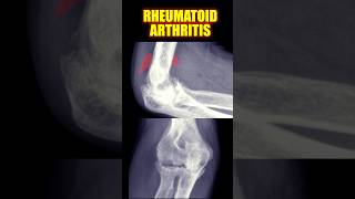 Rheumatoid Arthritis arthritis radiology doctor [upl. by Forester840]