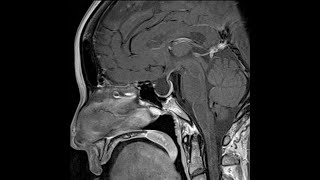 Endocrinology and DM Course Day 10 Empty Sella Syndrome Pituitary Hormones Deficiency and etc [upl. by Etnoid]