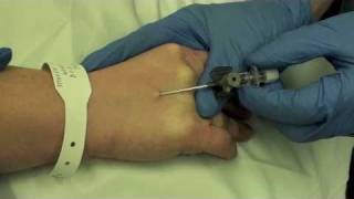 Local Anaesthesia for Venous Cannulation [upl. by Nottap]