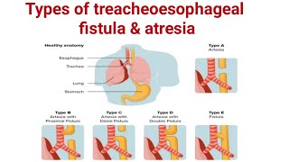 Types of treacheoesophageal fistula amp Atresia ll TEF ll pediatrics ll medical education [upl. by Frodi917]