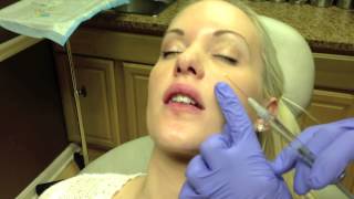 Botox amp Juvederm Lip Injection in Virginia by Dr Naderi DC VA MD [upl. by Vola]