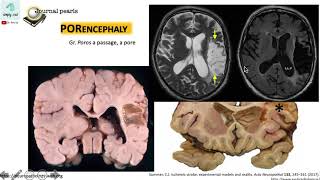 Porencephaly versus Schizencephaly 12 [upl. by Ailet]