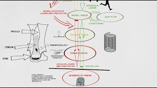 Tendinopathy Continuum and Update [upl. by Anividul]