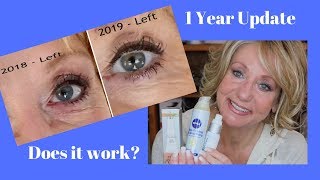 RetinA and Retinol Treatment for Deep Eye Wrinkles  Before and After [upl. by Ytsur869]