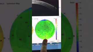 Keratoconus Careful evaluation of Pentacam and Optovue epithelialthickness maps Kanellopoulos MD [upl. by Hairabez711]