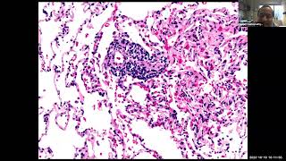 Board Review for Pulmonary Fellows version 2 with UCSF fellows [upl. by Dewees]