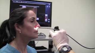 Esophagoscopy Without Sedation TransNasal Esophagoscopy Esophagus Exam Endoscopy [upl. by Dorothi]