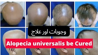 How to Cure Alopecia universalis ⁉️  Reasons amp Cure I Dua Session 900 [upl. by Karita672]