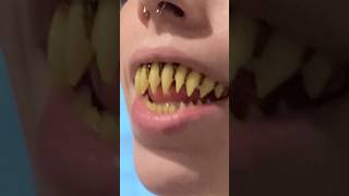 Why Is This FRIGHTENING Tooth Trend Is Taking Over 🧛🦷 [upl. by Onyx]