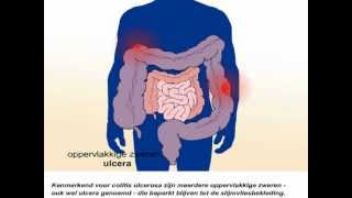 Colitis ulcerosa  Wat zijn de symptomen en behandeling van colitis ulcerosa [upl. by Noremak]