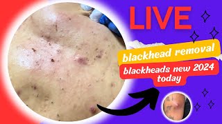 Blackheads new 2024 today blackhead removal THE BEST VIDEOS OF BURSTING blackheads and whiteheads [upl. by Odnamra983]