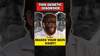 Did you know Unraveling Hypertrichosis Excessive Hair Growth Called as werewolf syndrome [upl. by Ettenoj243]