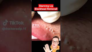 Crazy Painful BLACKHEAD REMOVAL AROUND LIPS  Super Satisfying shorts [upl. by Drus421]