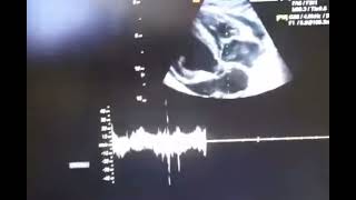 Echo cardiography of cardiac tamponade [upl. by Otina]