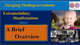 Leukemia Symptoms and Imaging Findings Video 1 [upl. by Mcclain634]