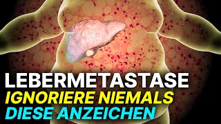 Lebermetastase Diese Symptome NIEMALS ignorieren [upl. by Cychosz985]