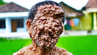 Trypophobia Lovers  5 Weird Skin Conditions [upl. by Ruperta]