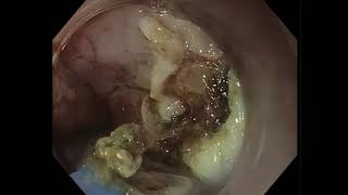 Hybrid APC for dysplastic Barretts esophagus [upl. by Anitnas258]