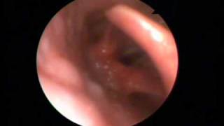 Vocal cord dysfunction syndrome  Video laryngoscopy [upl. by Sanalda]