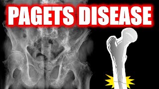 Paget Disease of Bone explained under 5 minutes [upl. by Polito]