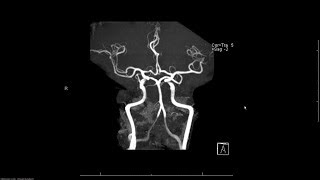 MRA magnetic resonance angiogram head radiology search pattern [upl. by Agretha]