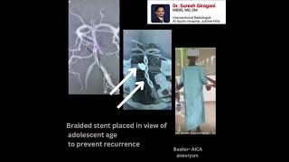 Dr Suresh Giraganis Success with Flow Diverter in Treating Complex Left ICA Aneurysm [upl. by Dnalyar]