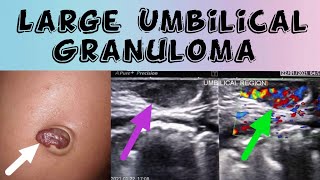 Large Umbilical Granuloma  Umbilical Swelling Ultrasound [upl. by Trela]