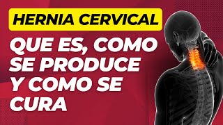 HERNIA CERVICAL C5C6 SINTOMAS TRATAMIENTO Y EJERCICIO ✅ [upl. by Vilma]