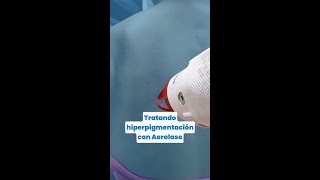 Trata la hiperpigmentación con Aerolase [upl. by Nnairahs]