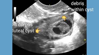 Viable intrauterine pregnancy with corpus luteal cyst of ovary ultrasound and color Doppler video [upl. by Gniy]